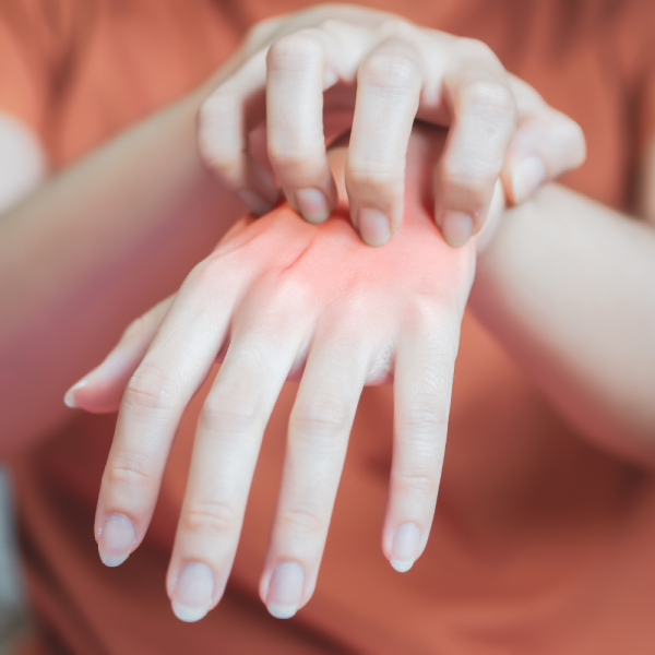 Разница между пищевой аллергией и атопическим дерматитом